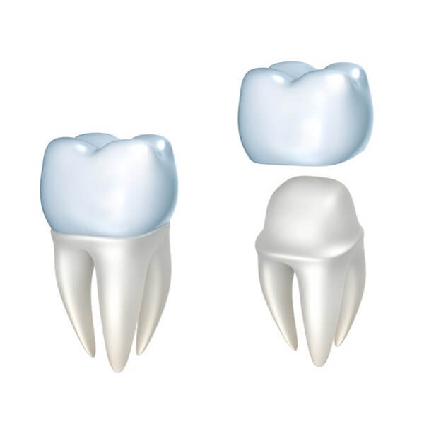 Dental Crowns