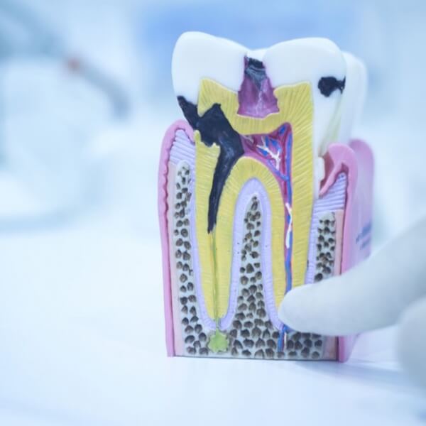 Root Canal Treatments