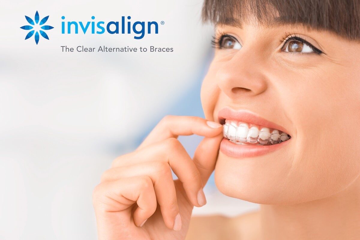 The Benefits of Invisalign: Not Just Popular, It’s the Picture Perfect Solution