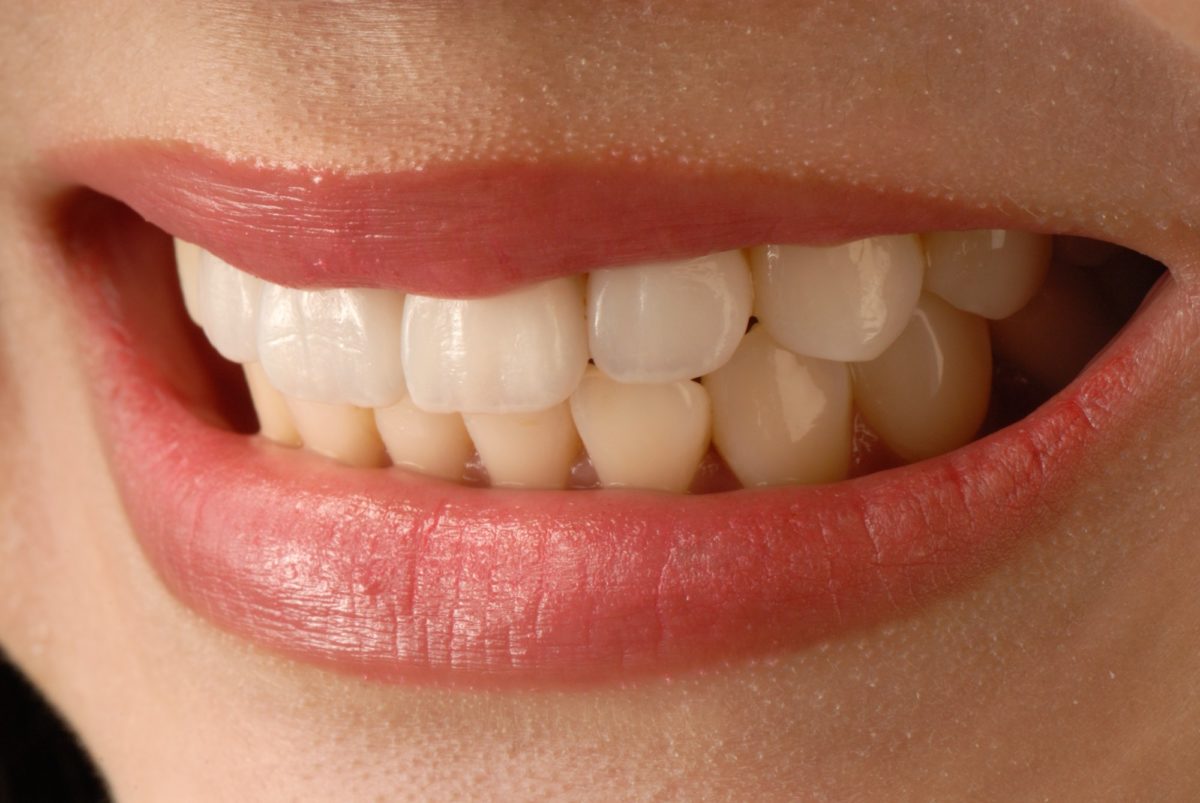 Smile Big: 10 Reasons to Get Veneers